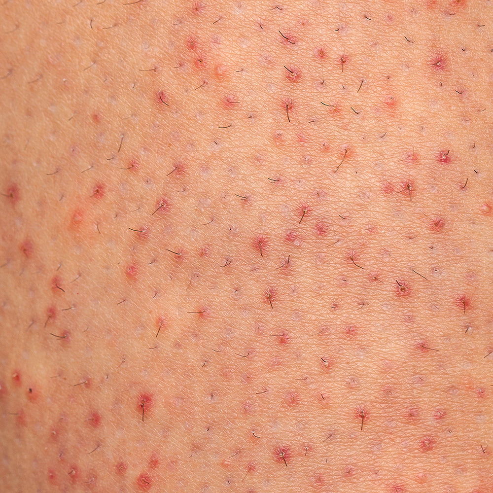 What Is Keratosis Pilaris, What Causes It, and How to Help Improve the Look of Strawberry Skin