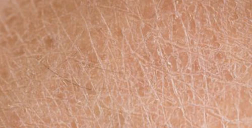Dry, Scaly Skin