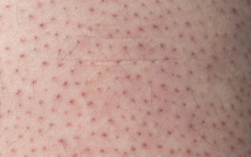 KP (Keratosis Pilaris)