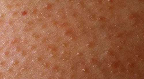 Rough, Bumpy Skin