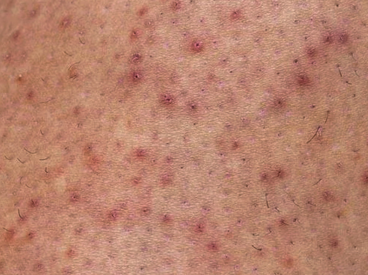 Keratosis pilaris