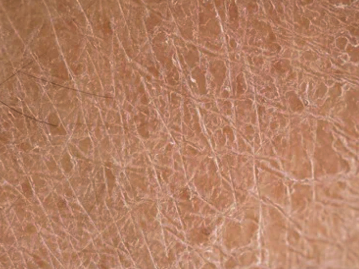 Dry, scaly skin